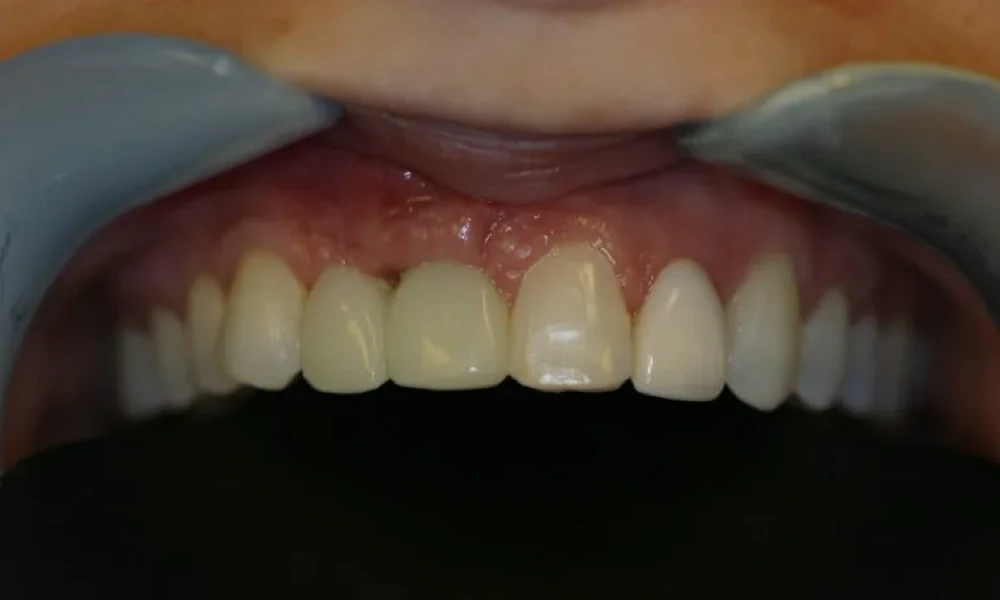 Clinical photo from Hope's smile reconstruction case